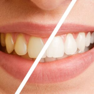Clareamente Convencional Idental